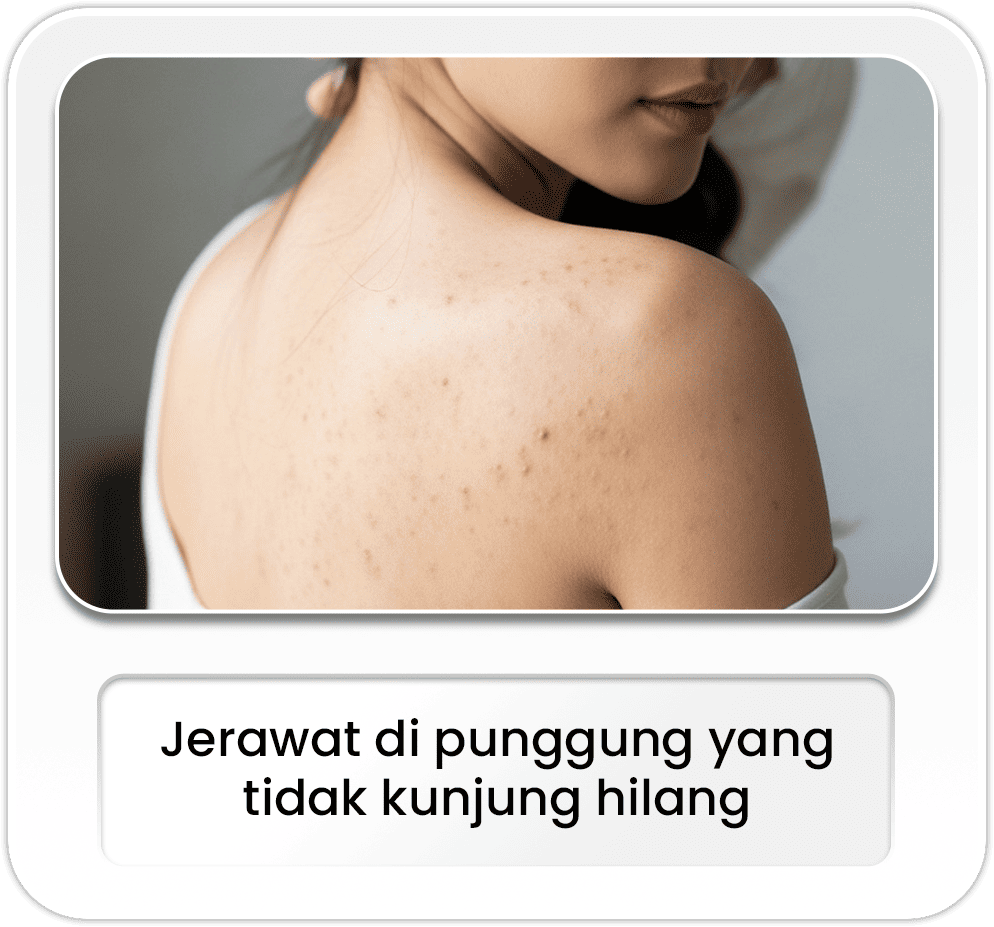 Jerawat di punggung yang tidak kunjung hilang.