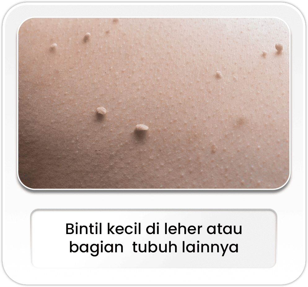 Bintil kecil di leher atau bagian tubuh lainnya