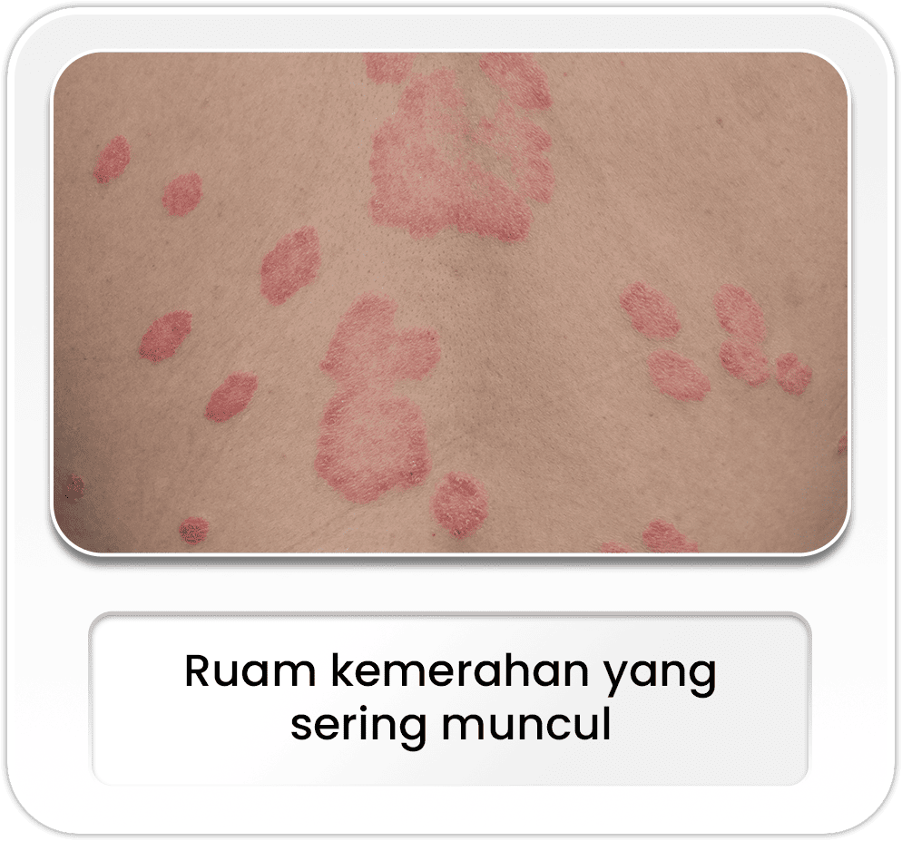 Ruam kemerahan yang sering muncul