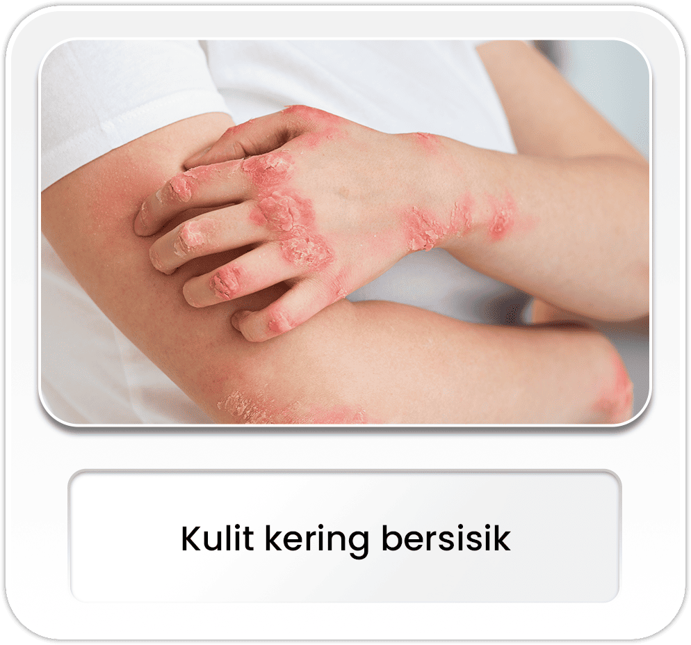 Kulit kering bersisik