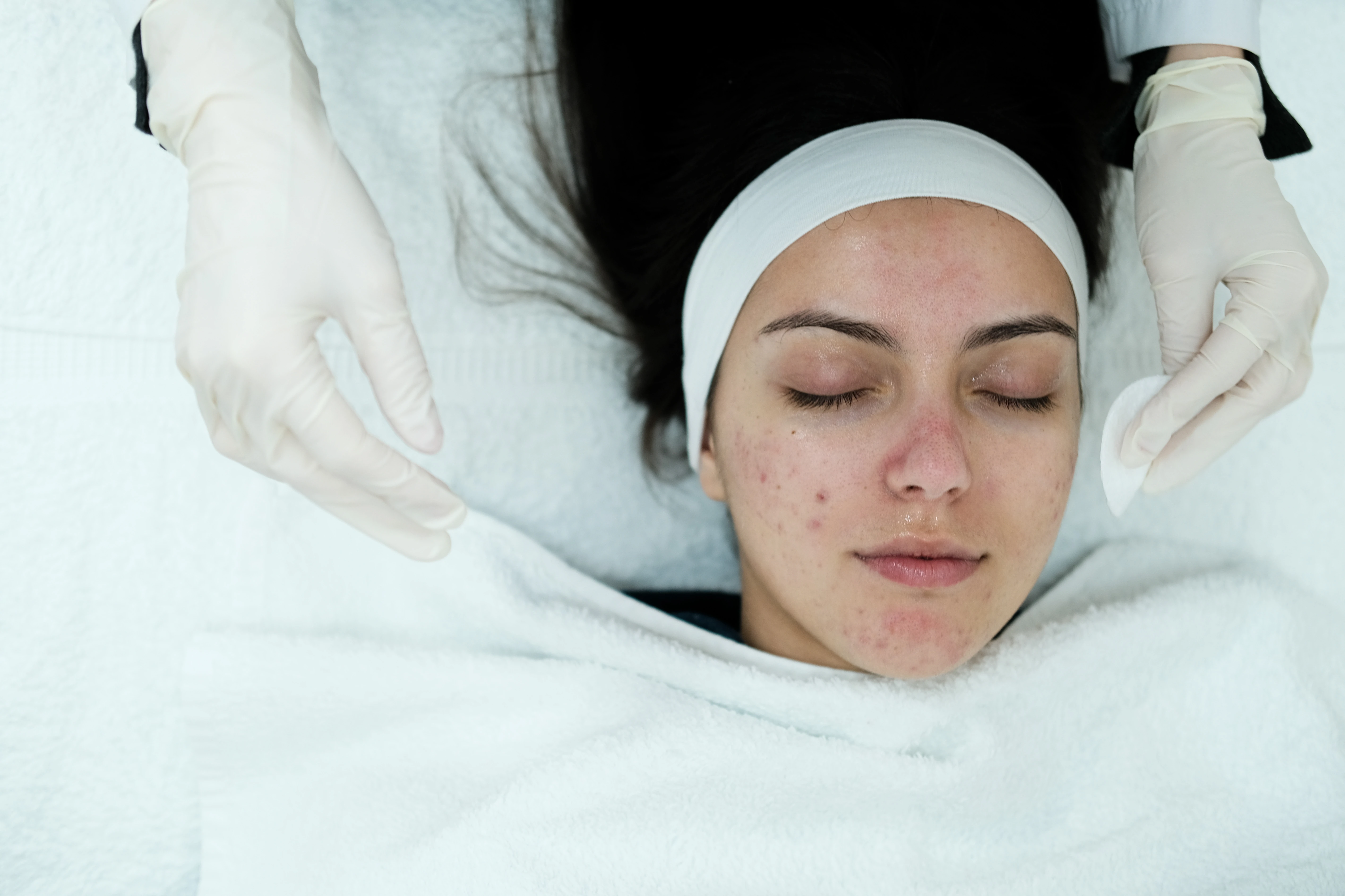 Konsultasi perawatan jerawat di Kusuma Beauty Clinic Clinic ACNE Specialist