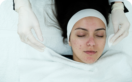 Acne Cure