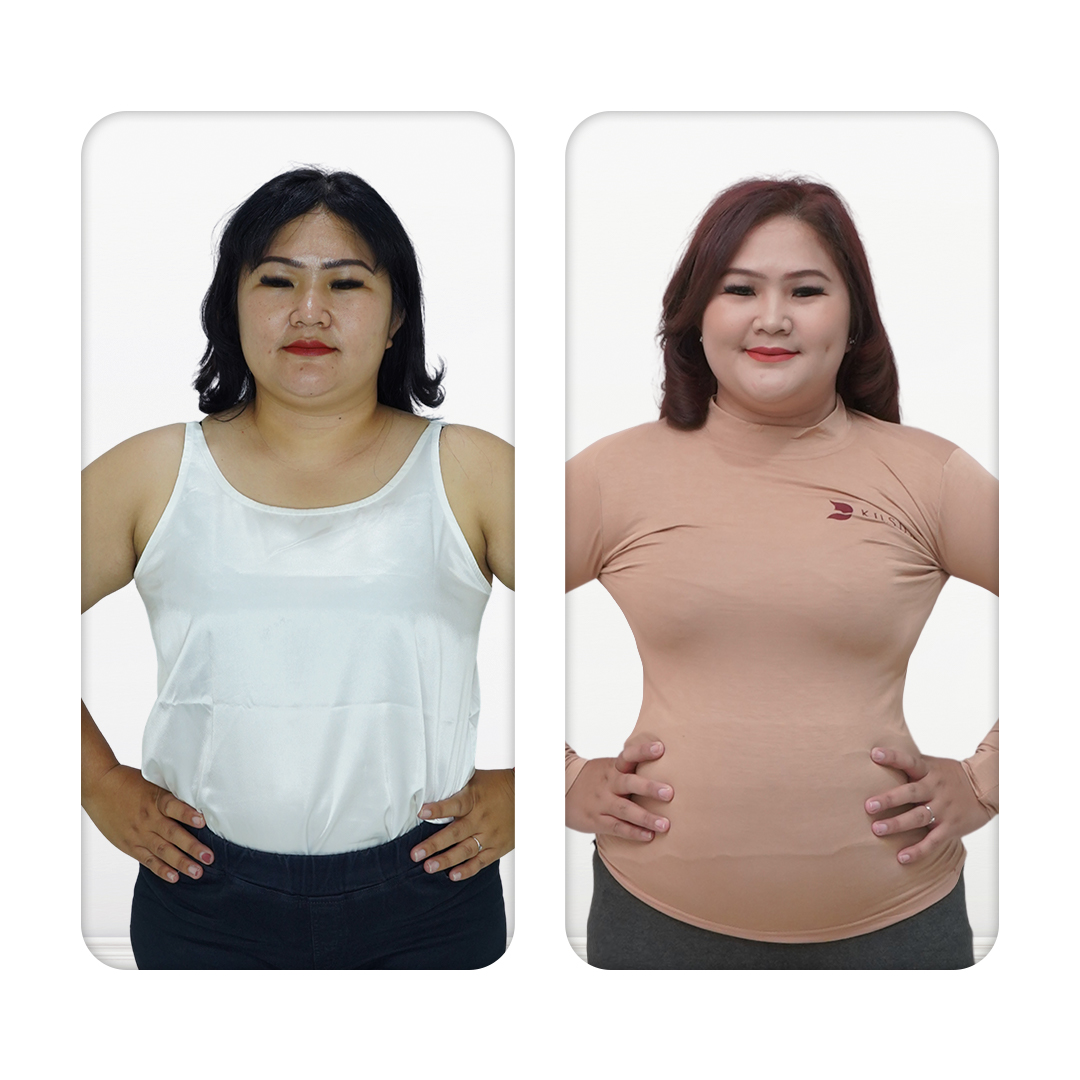 Before After Perawatan 4