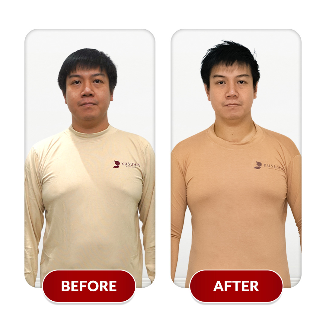 Before After Perawatan 1